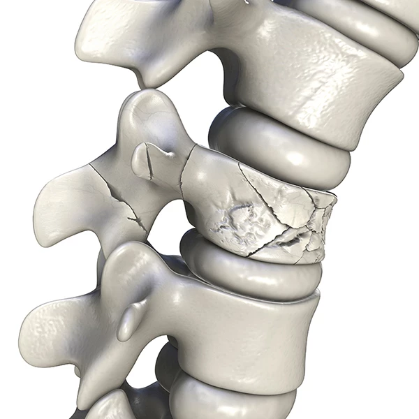 翻身就痛！脊椎壓迫性骨折靠椎體成型術挽救