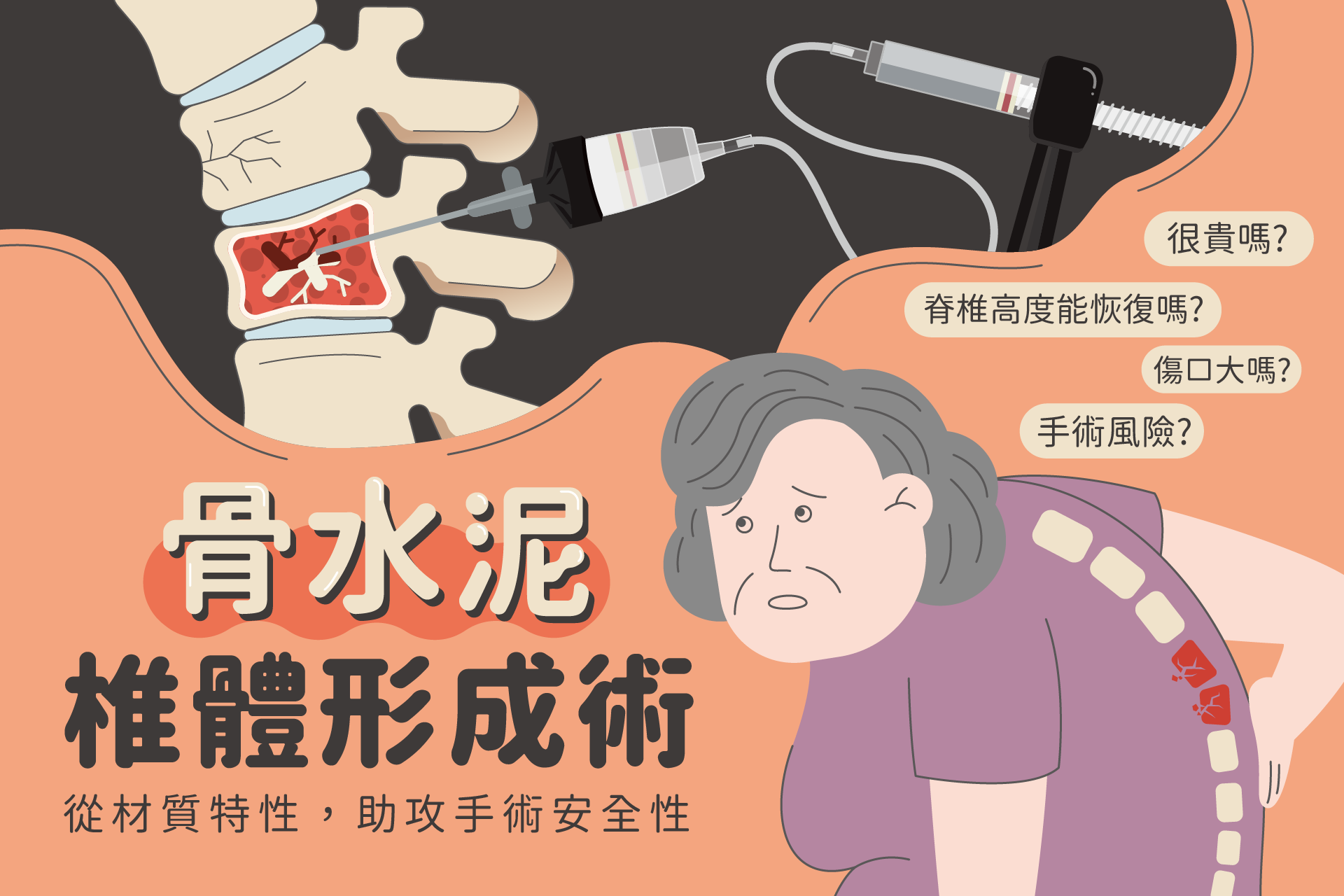 骨水泥治療脊椎骨折安全嗎？治療方法、健保給付條件與術後照顧