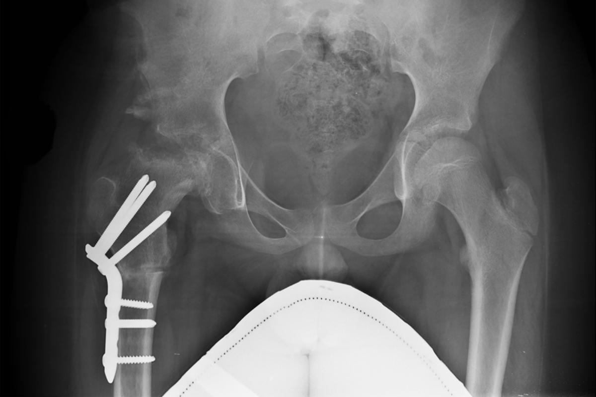 髖關節截骨矯正手術免換人工髖關節！原理、適應症、術後復健