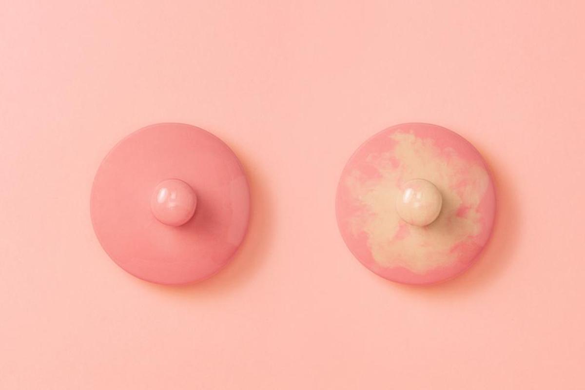 乳癌存活率有多少？症狀、前兆、檢查、治療方式