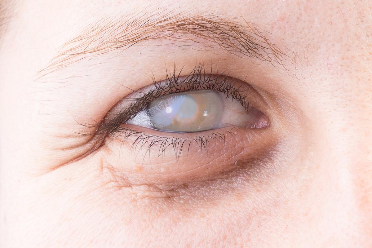 眼角膜受傷多久會好？角膜移植、圓錐角膜、症狀、治療一次看
