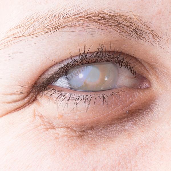 敏感易受傷的眼角膜 什麼情況需角膜移植
