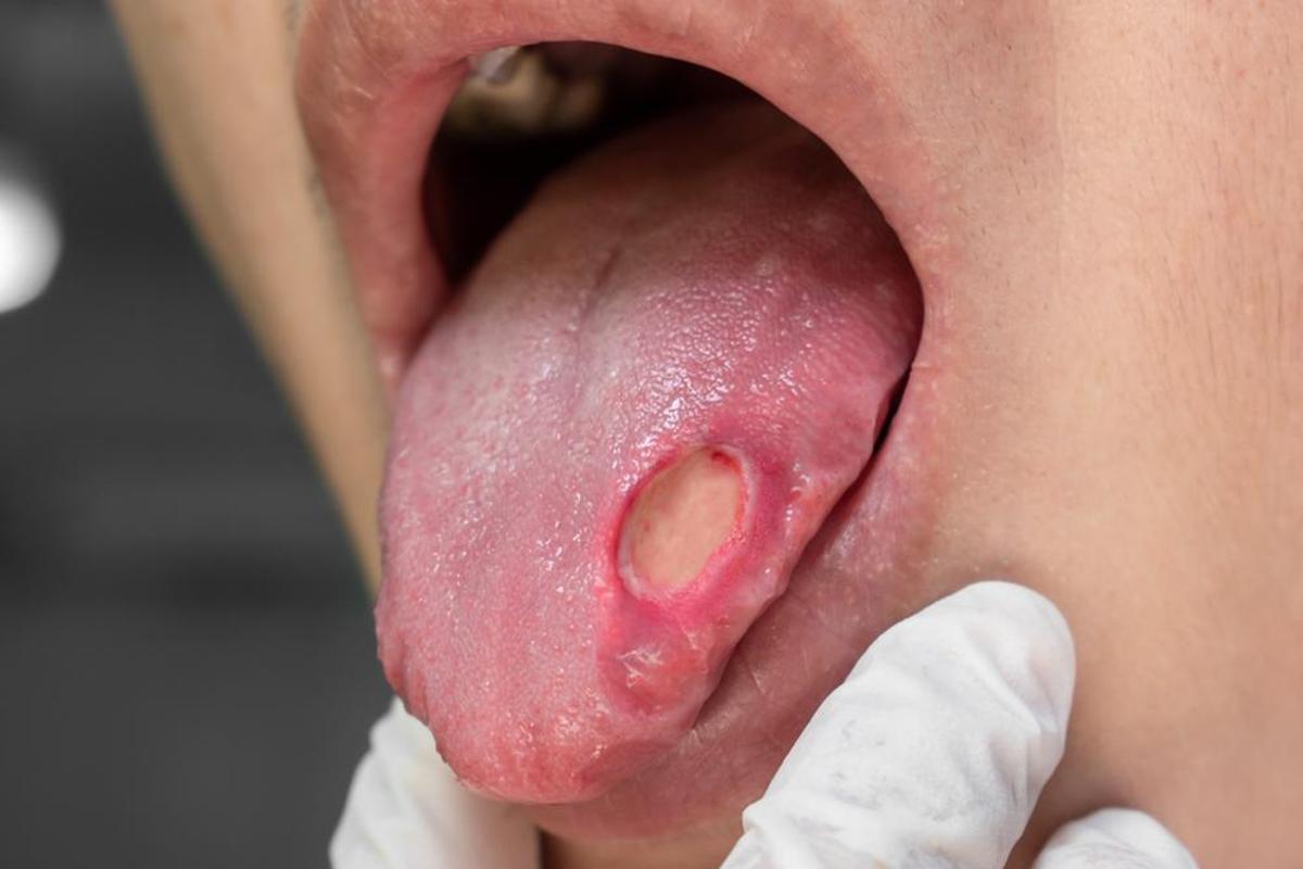 口腔癌不開刀會好嗎？初期症狀、存活率、治療及手術方法一次看