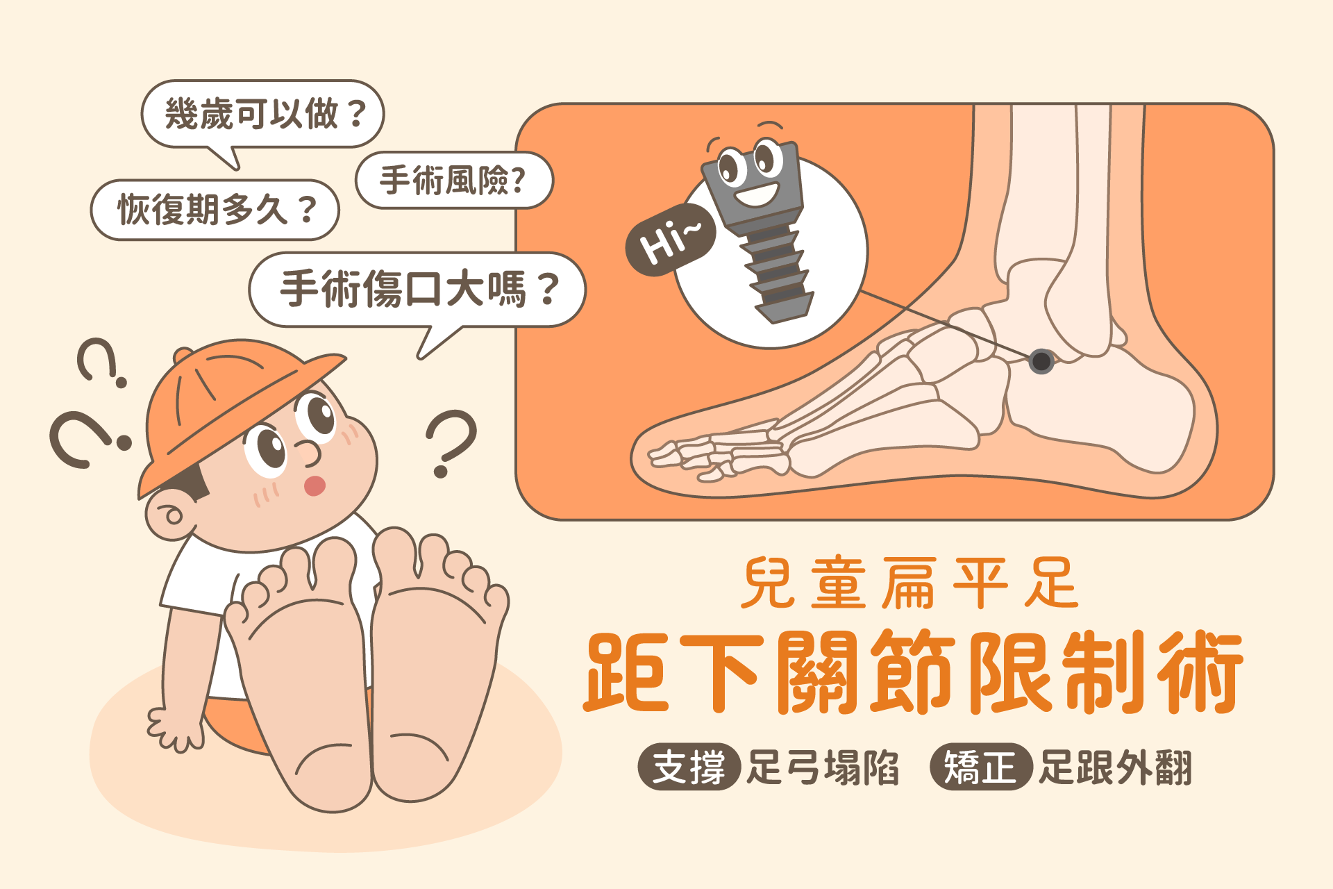 兒童扁平足怎麼辦？矯正兒童足弓塌陷及足外翻：距下關節限制術
