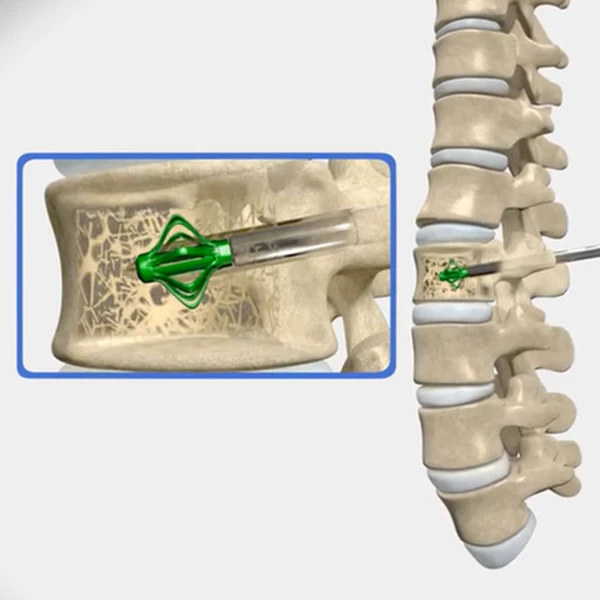 台每年6萬人脊椎骨折 MIT骨材救命手術免30分鐘