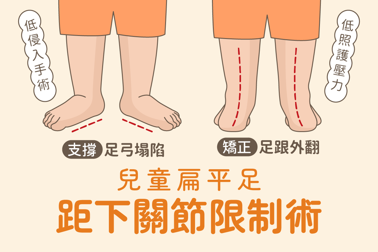 距下關節限制術(上)