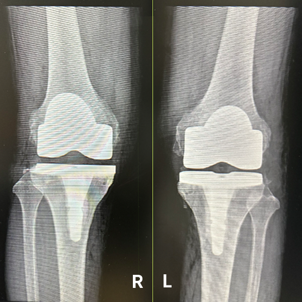 七旬老闆膝蓋痛15年變O型腿，ROSA機械手臂助人工膝關節置換術