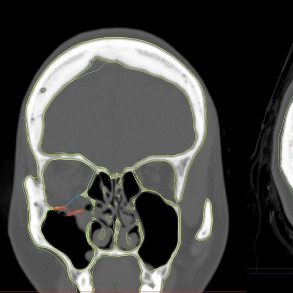 車禍撞擊眼底骨折眼窩垮了！內視鏡置入人工骨把眼球喬回原位