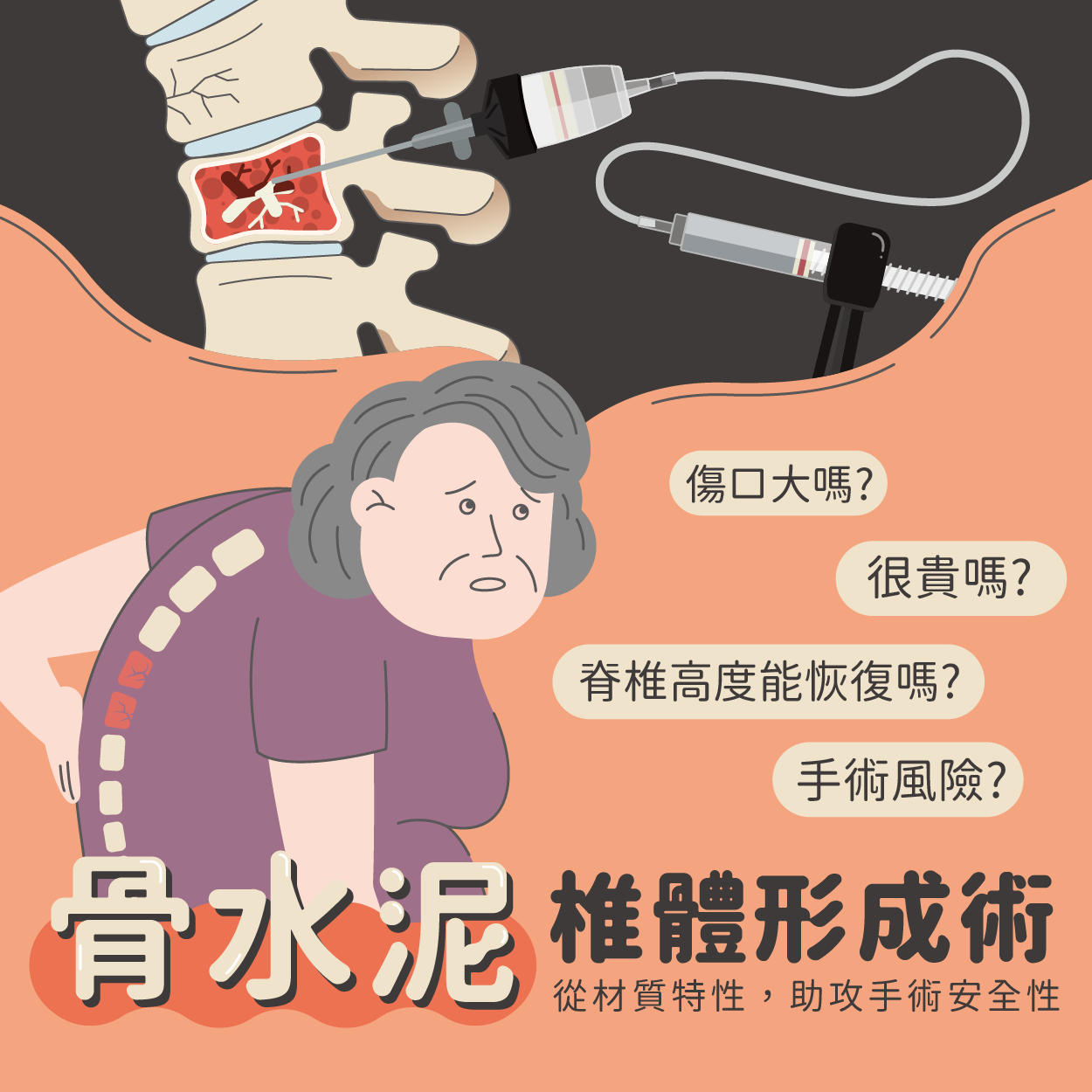 骨水泥治療脊椎骨折安全嗎？治療方法、健保給付條件與術後照顧
