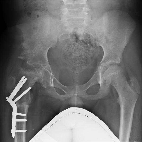髖關節截骨矯正手術免換人工髖關節！原理、適應症、術後復健