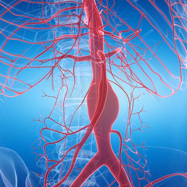 腹主動脈瘤成因？症狀、手術方式、成功率、費用