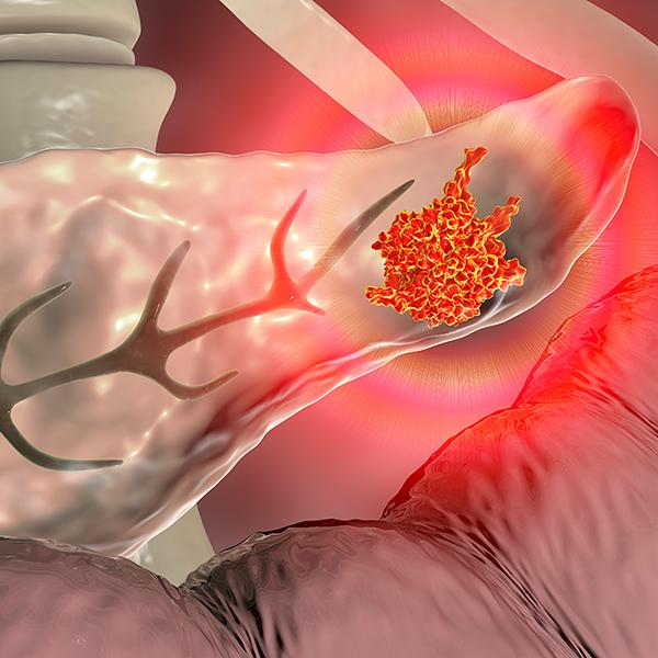 胰臟癌存活率高嗎?罹病原因、症狀、末期治療方式