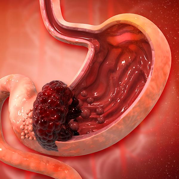 胃癌症狀如何早期發現?前兆、存活率、治療方式