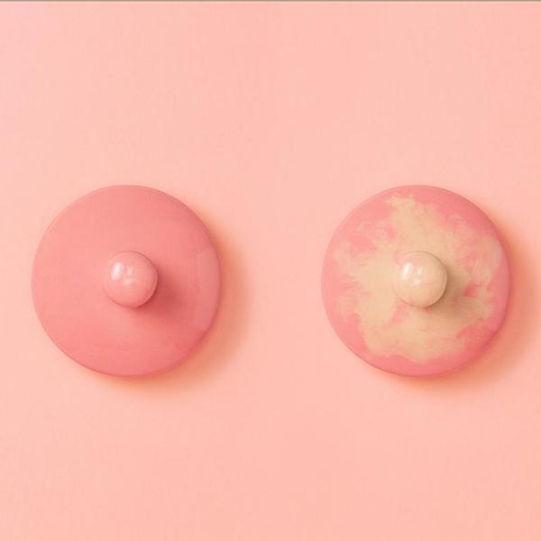 乳癌存活率有多少?症狀、前兆、檢查、治療方式
