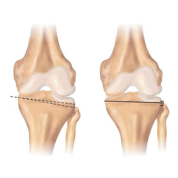 保膝手術治療膝蓋退化，免換人工膝關節！手術原理、術後照顧