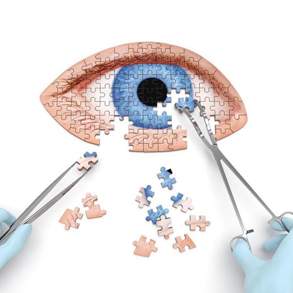 白內障害眼睛變熟了！症狀、原因、人工水晶體、術後照顧