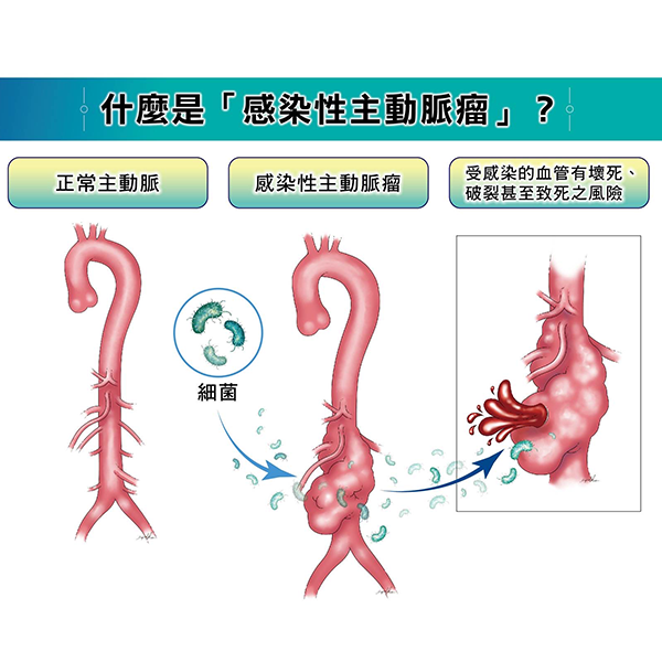 林口長庚發表重量級主動脈疾病研究:  感染性主動脈瘤行開放性手術修補仍為長期救命關鍵