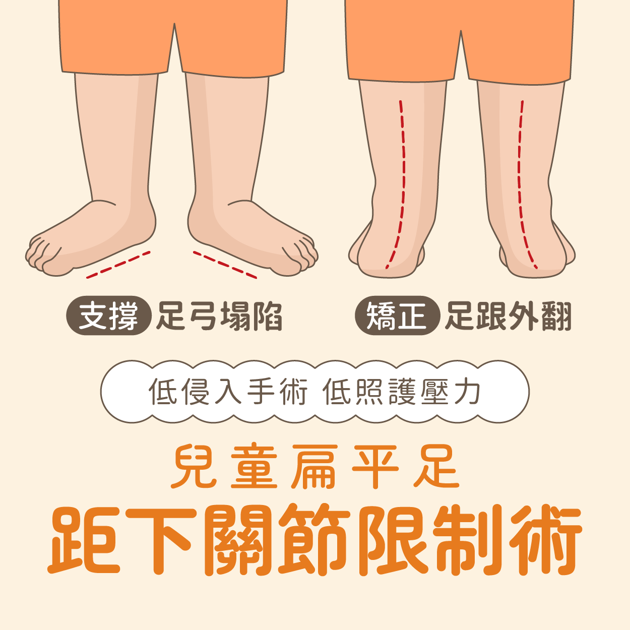 兒童扁平足距下關節限制手術專題