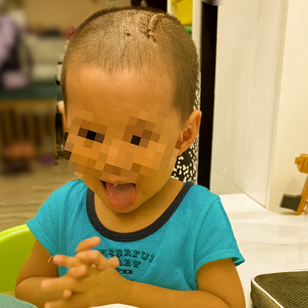 三歲童上舖跌落險喪命 耕莘醫院緊急開顱救回一命