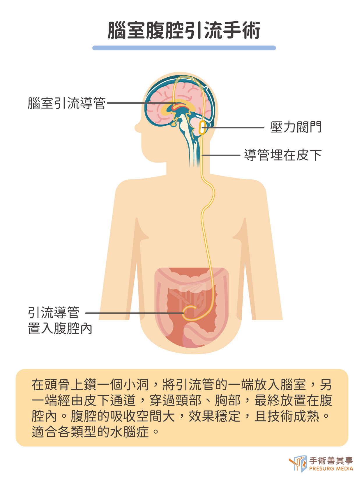 腦室腹腔引流手術示意圖