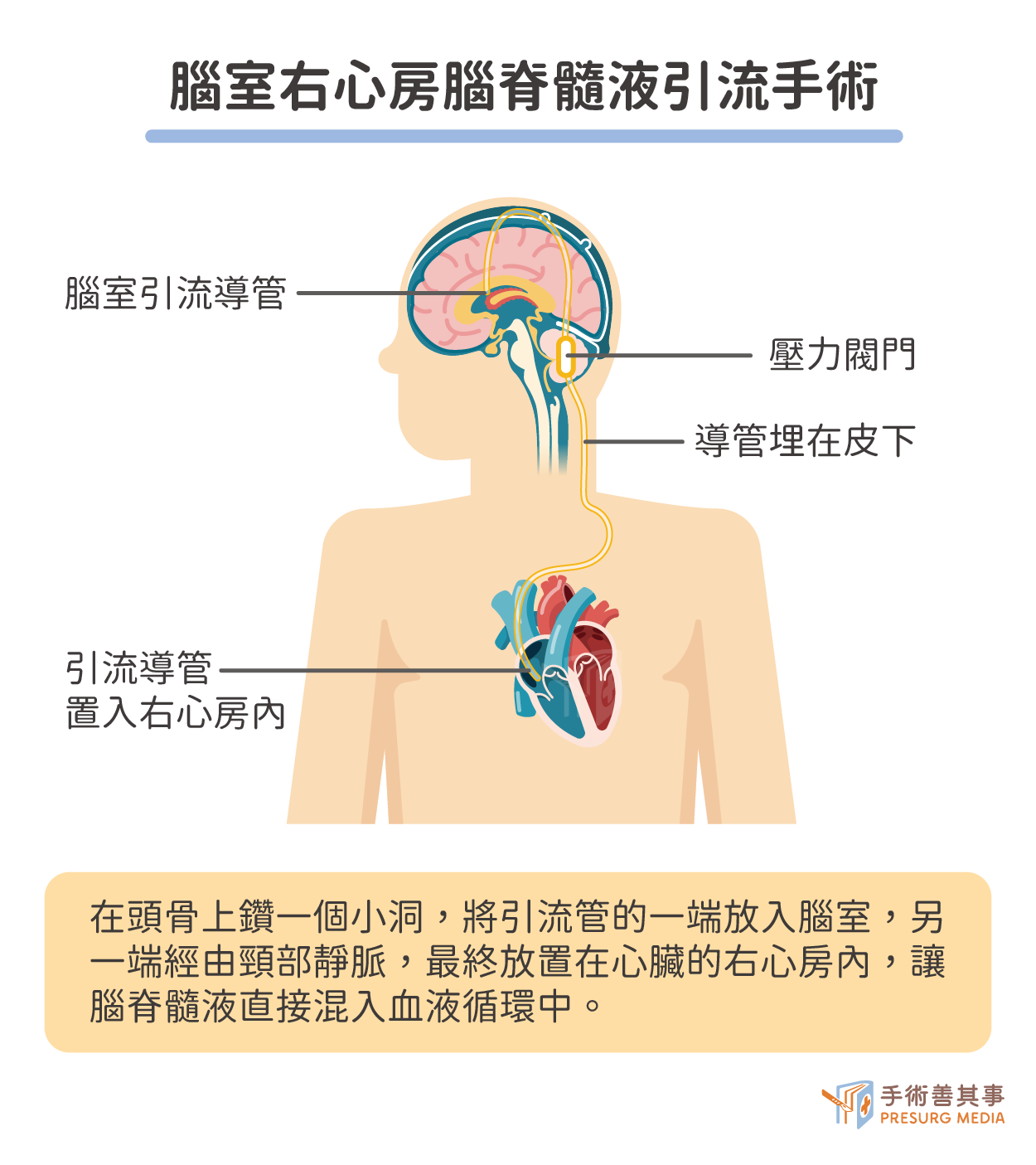 腦室右心房引流手術示意圖