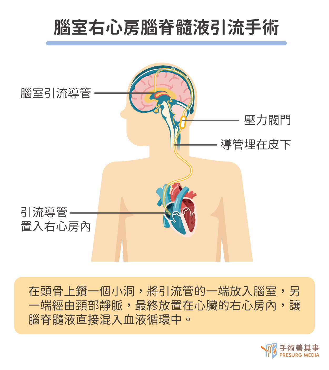 腦室右心房引流手術示意圖