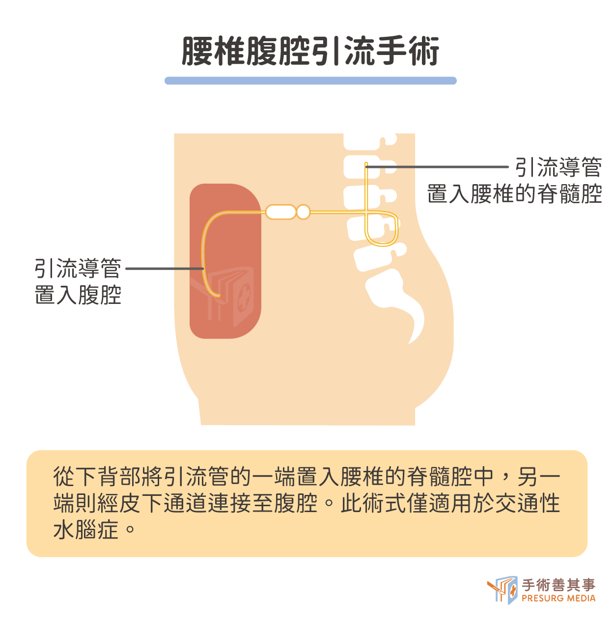 腰椎腹腔引流手術示意圖