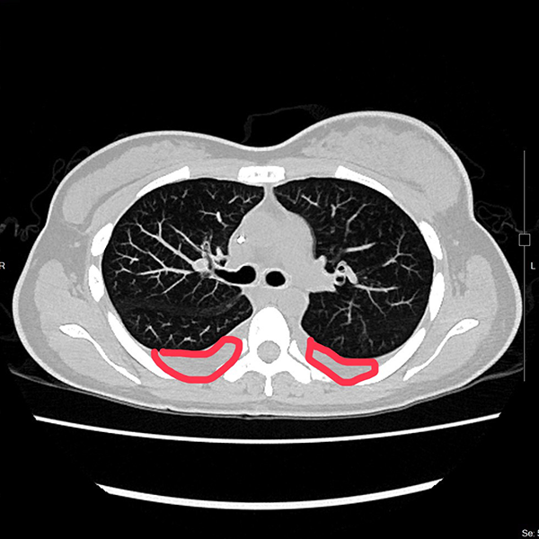 以為只是小腫塊,竟是乳癌第四期! 醫:及早篩檢最關鍵
