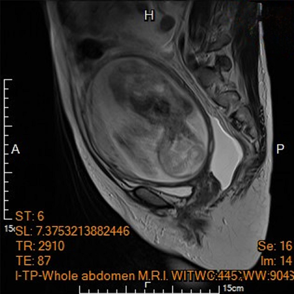 孕婦產檢 腹內藏巨大危機 卵巢惡性腫瘤幸未轉移 手術摘除免化療 順利足月生產