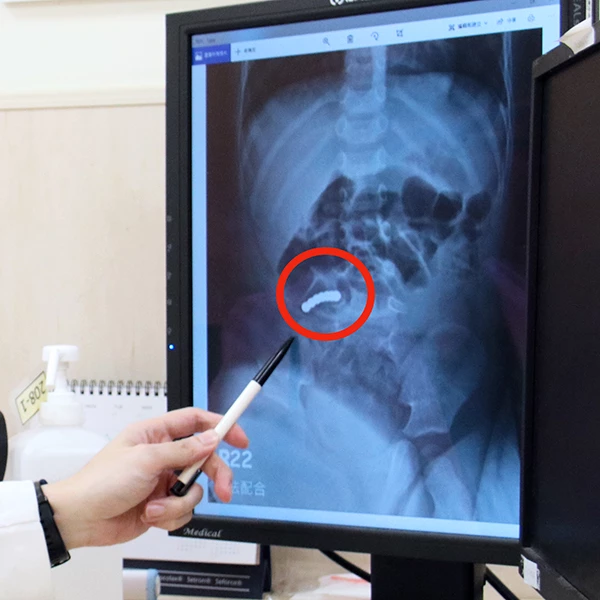 2歲童腹痛送急診 醫一照發現「7顆巴克球」緊黏大小腸