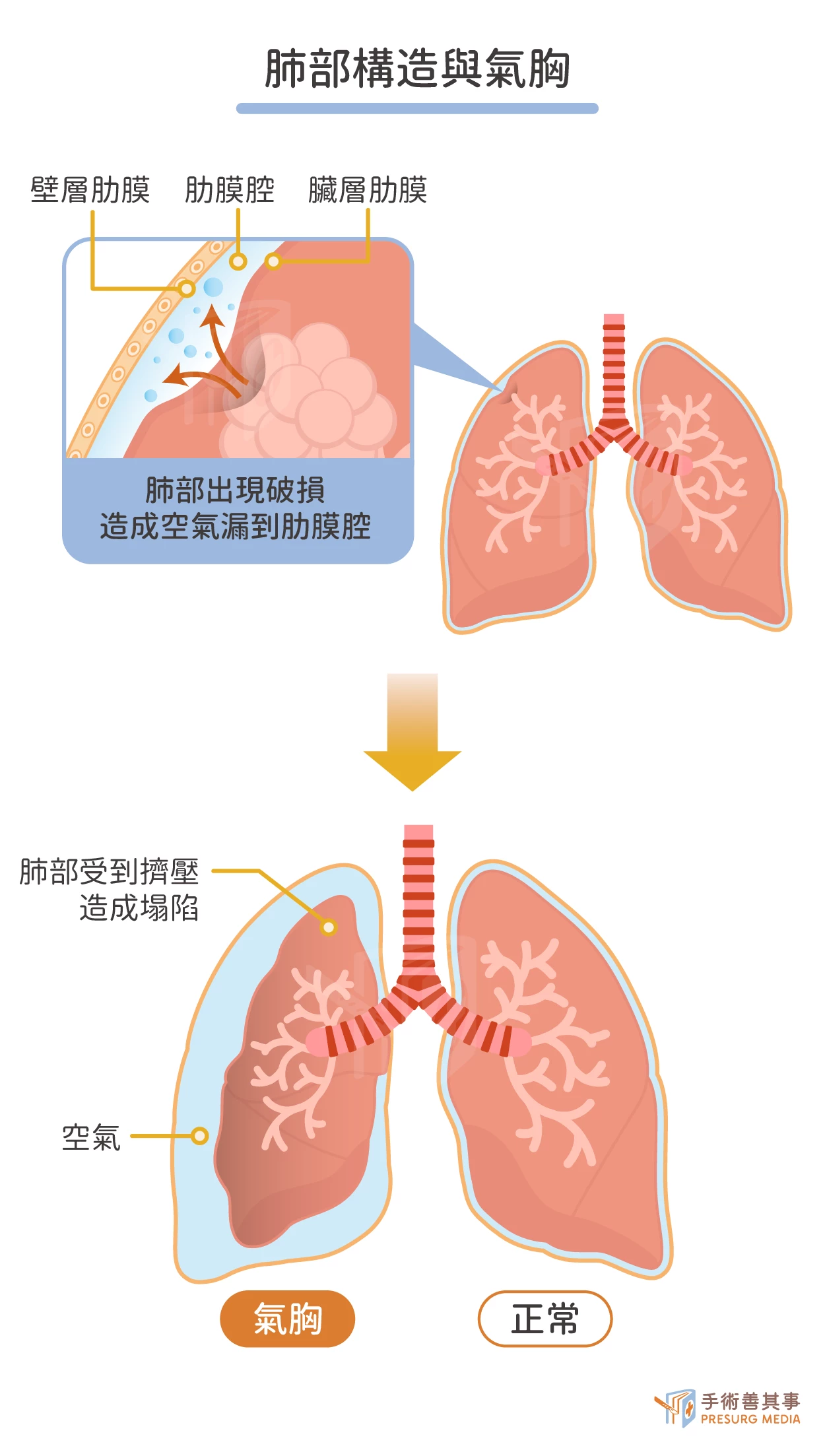 图2—34 急性血行播散性肺结核合并右侧胸膜炎-特种医学-医学