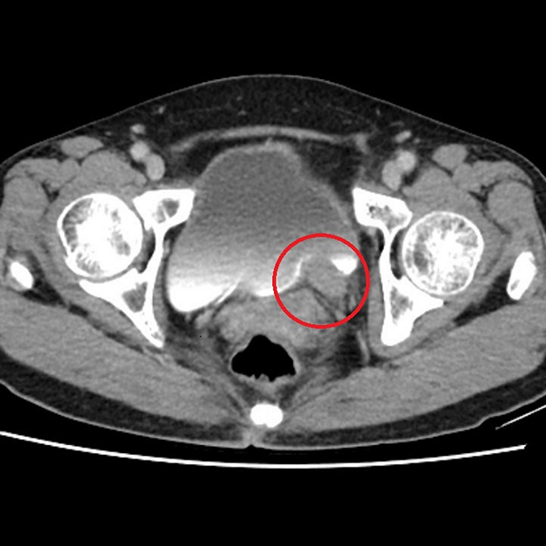 無痛血尿竟是罹癌 手術根除病灶並保留腎臟
